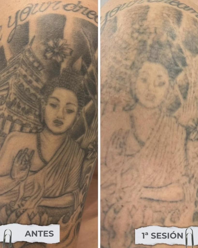 Tatuaje grande de Buda en el brazo antes y después de la primera sesión de láser en ASH Studio