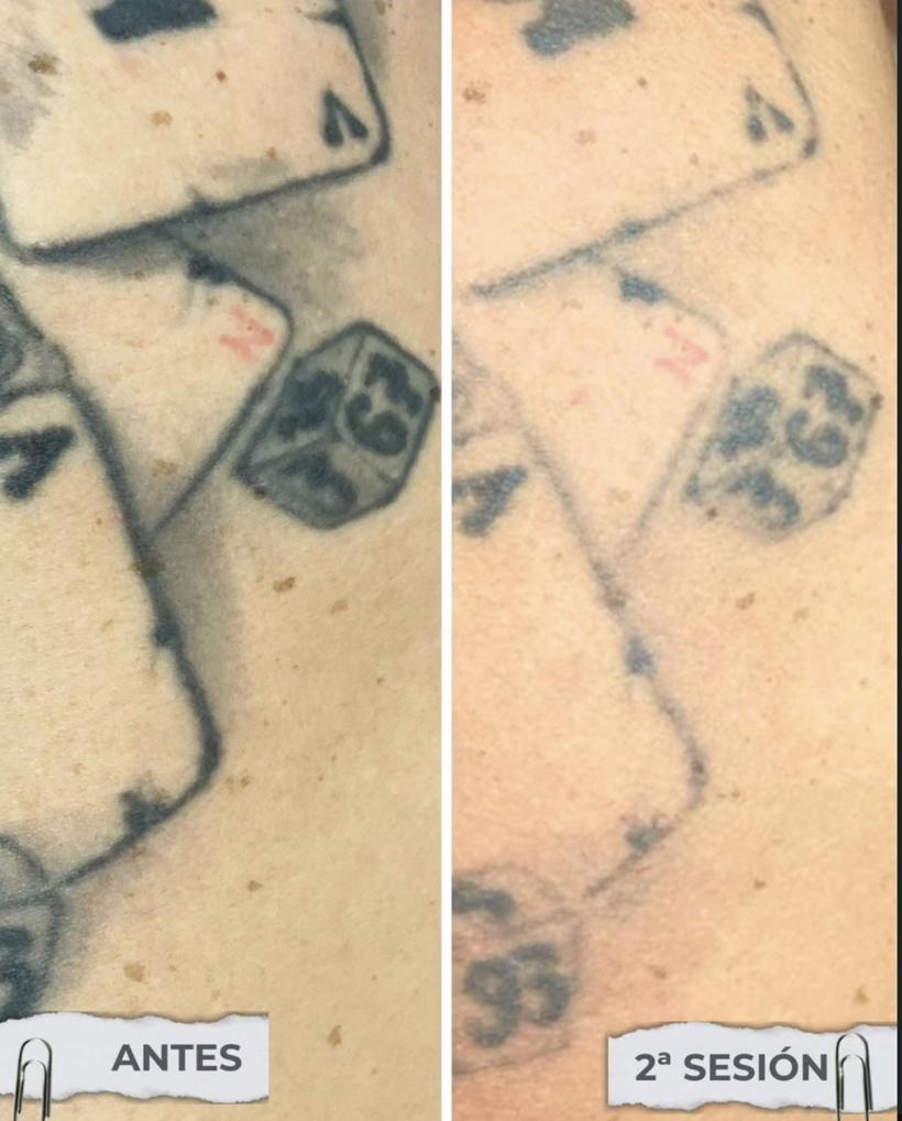 Tatuaje de cartas y dados con detalle rojo antes y después de 2 sesiones de láser