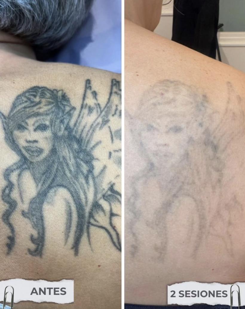 Tatuaje de hada en la espalda antes y después de 2 sesiones de láser