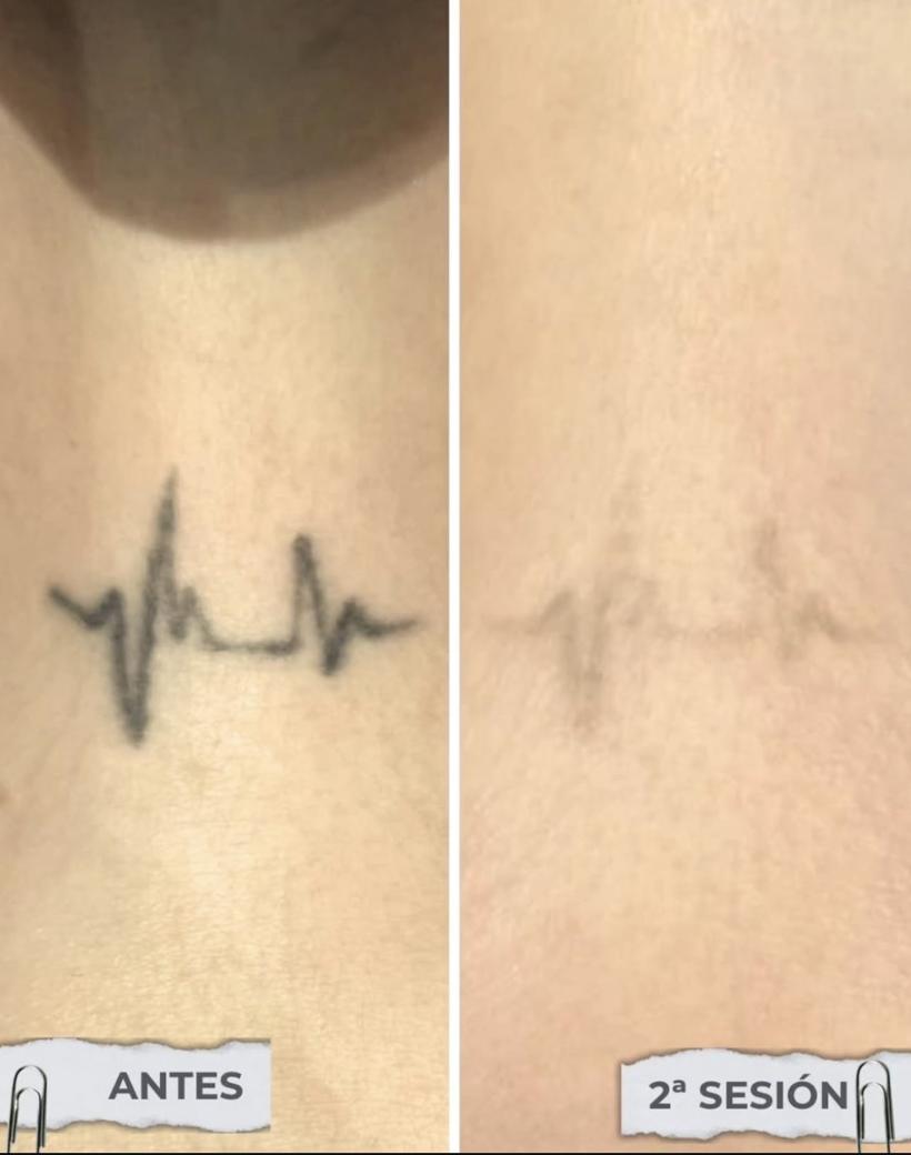 Tatuaje de latido en el cuello antes y después de 2 sesiones de láser