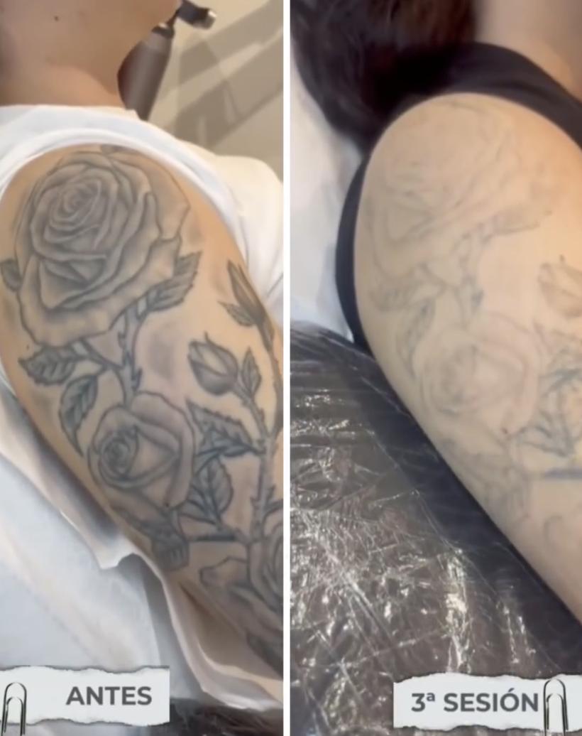 Tatuaje grande de rosas en el brazo antes y después de 3 sesiones de láser